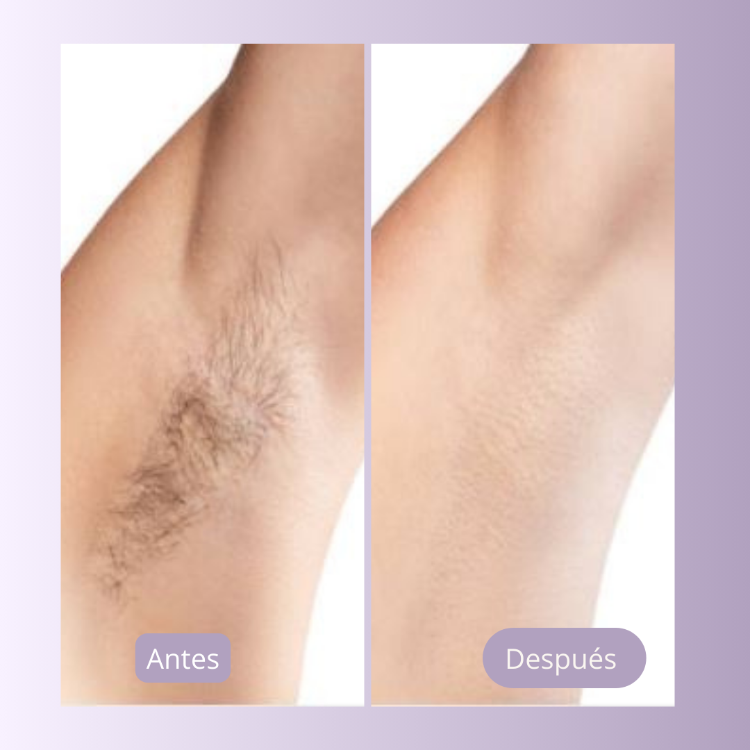 Luma Derm ™ | Depilador Láser IPL