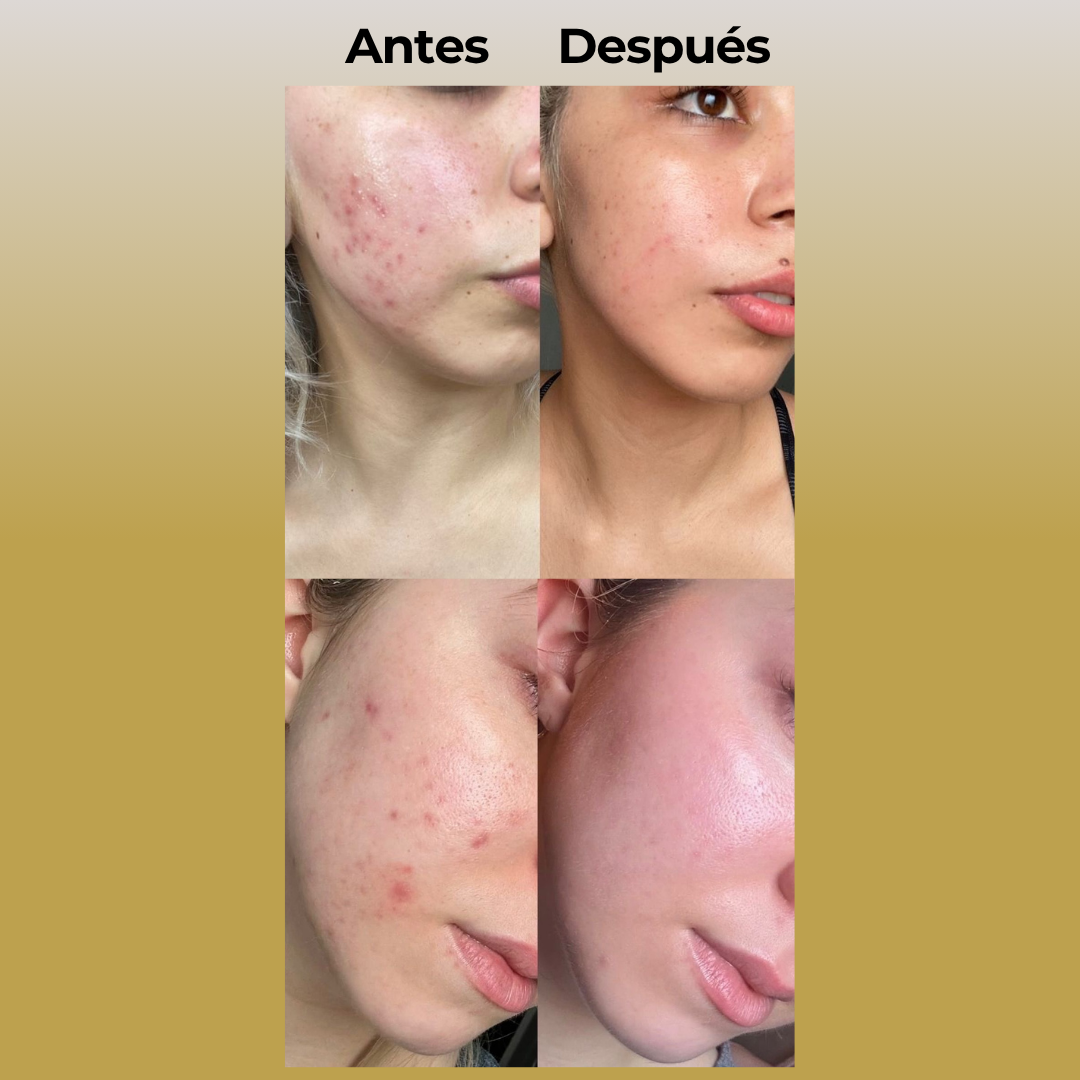 Lumea™ | Mascara Cuidado Facial Led